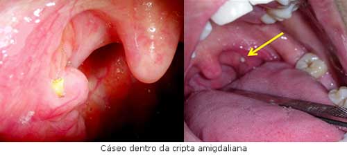 Caseum ou Bolinhas na Garganta